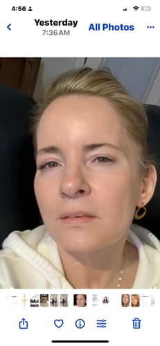Reviewer selfie showing smooth skin after a micro-infusion treatment using the Sterile Needle Heads.