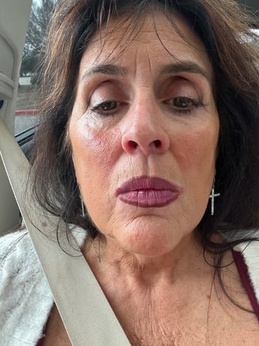 Customer photo review of Maximum Instant  Filler Lip Plumper (3ml)