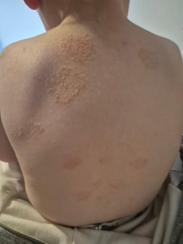 Reviewer's photo of a child's back with dry, irritated skin patches before using Hemp Seed Butter.