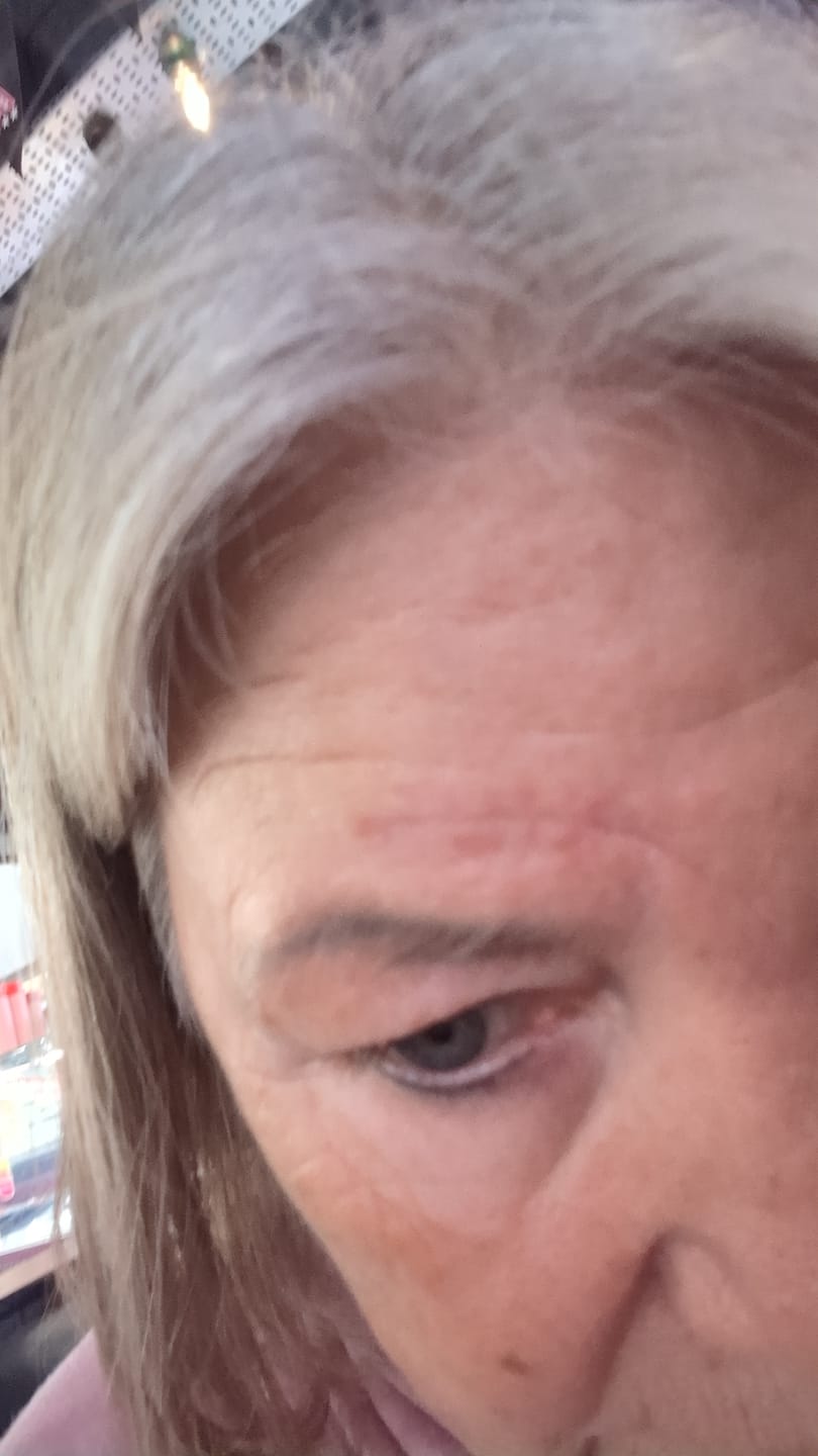 Customer photo review of Calm Skin-Relief Kit