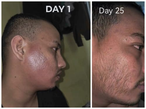 Customer photo review of Minoxidil High Strength (5%) SOLUTION, 3x60ml pack