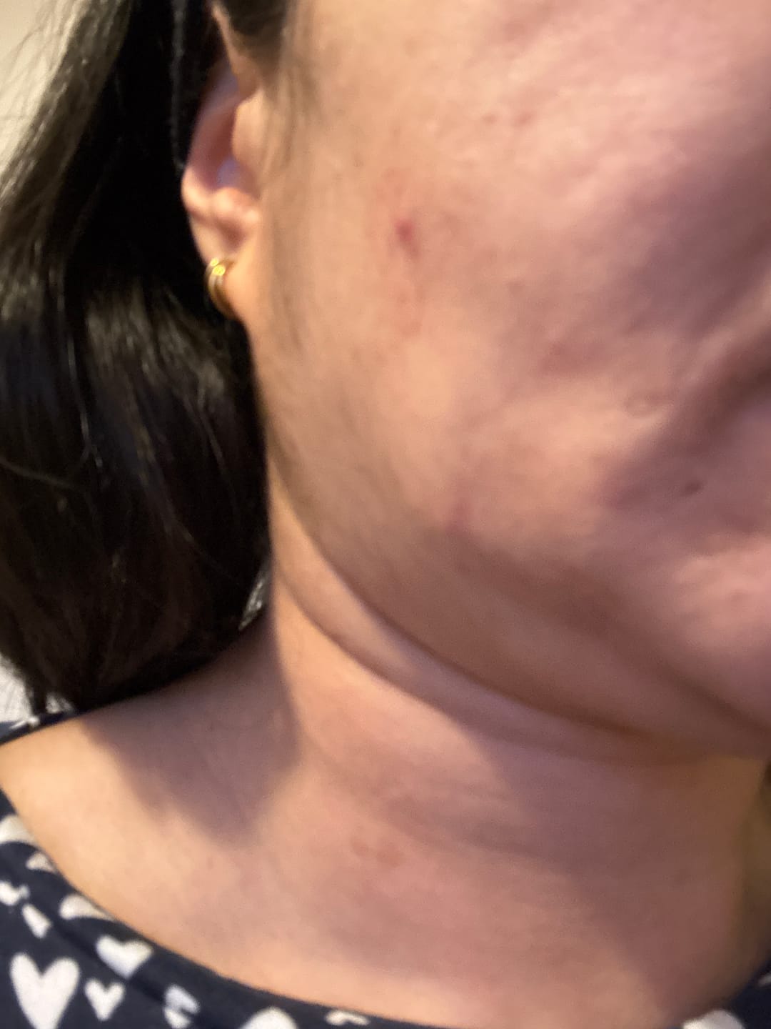 Customer photo review of Kill Acne & Redness Ritual