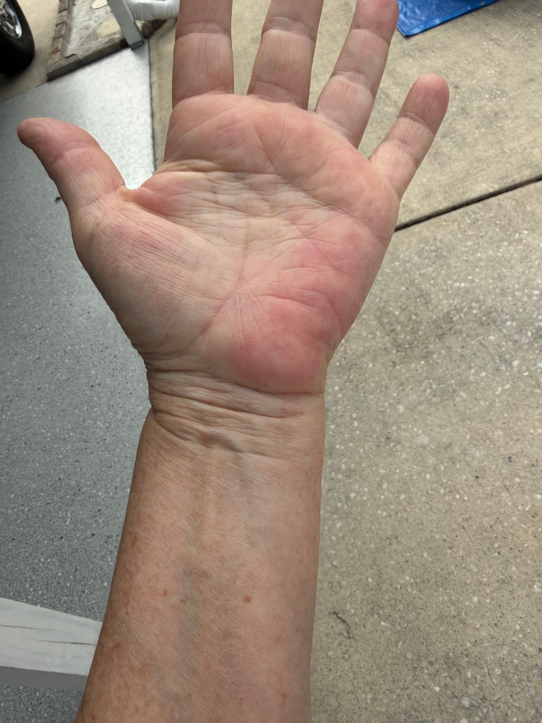 Customer photo review of Neuropathy Support Sample 4 Pack