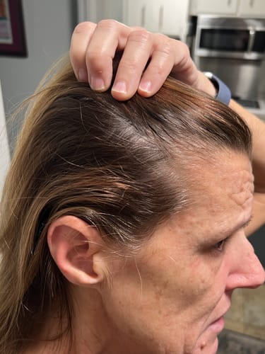 Customer pulling back their hair to show the scalp and hairline, described as a 'before' photo.