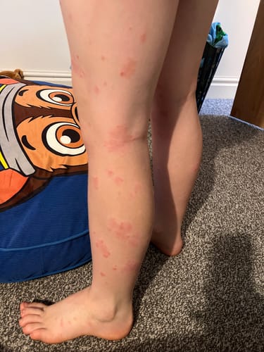 Customer's photo showing a person's legs covered in red, inflamed patches of psoriasis before using the Multi Strain Biotic.