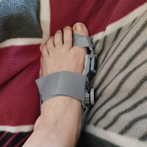 Vásárló lába az Ortolin éjszakai bütyökvédő és lábujj korrigáló sínben.