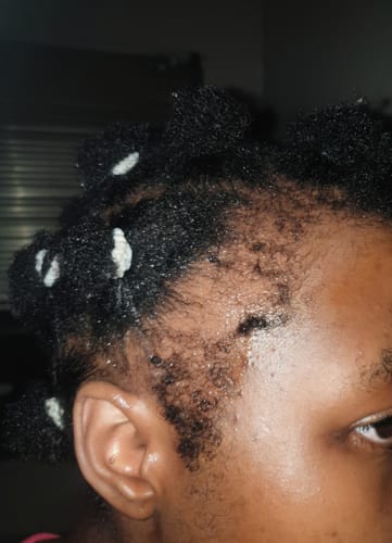 Customer photo review of Minoxidil REGULAR (2%) strength SOLUTION, 3x60ml pack