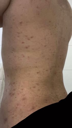 Reviewer's back showing widespread acne before using the 5 ENTRIES product.