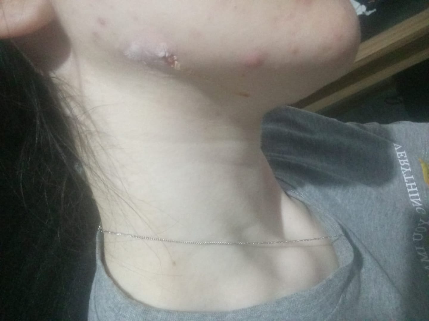 Customer photo review of Akne Karşıtı Losyon