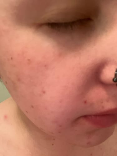 Reviewer's close-up of their face showing acne, which improved after using the Face Cleanser.