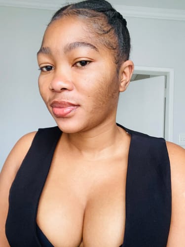 Customer photo review of Minoxidil High Strength (5%) SOLUTION, 3x60ml pack