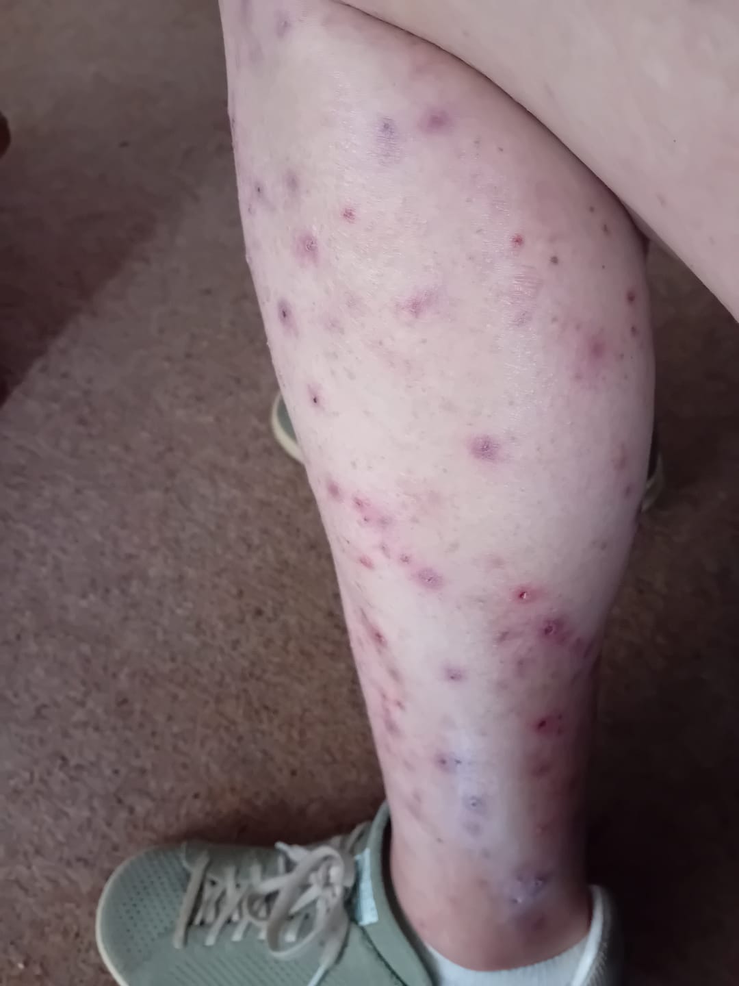 Customer photo review of Bioskin Duo Pack
