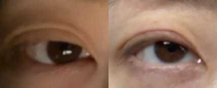 Customer photo review of Optifold EyelidShaping™ Tapes (Standard Pack)