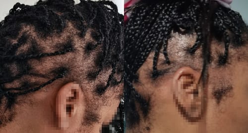 Customer photo review of Minoxidil High Strength (5%) SOLUTION, 3x60ml pack