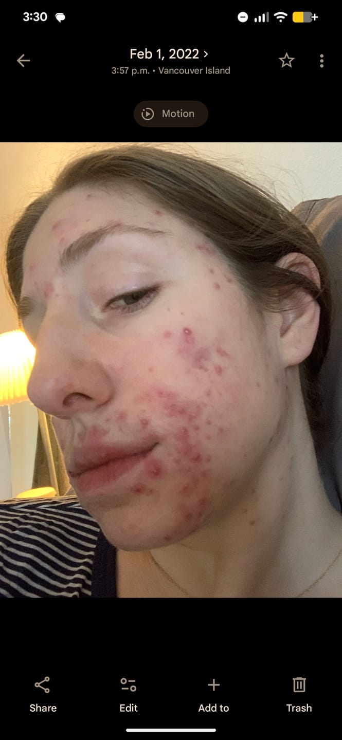 Customer photo review of Acne Formula