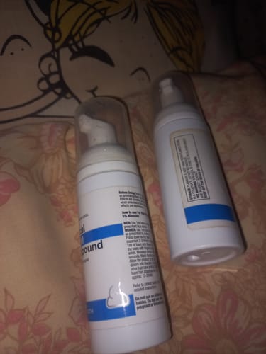 Customer photo review of Minoxidil High Strength (5%) FOAM, 3x60ml pack