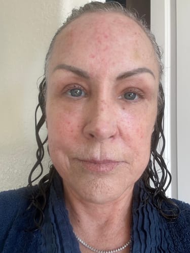 Reviewer's face showing some redness after a treatment with the Seranova Micro Infusion System.