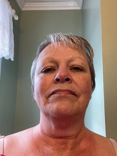 Reviewer's face before using the balm, showing redness on the cheeks and a prominent age spot on the eyelid.