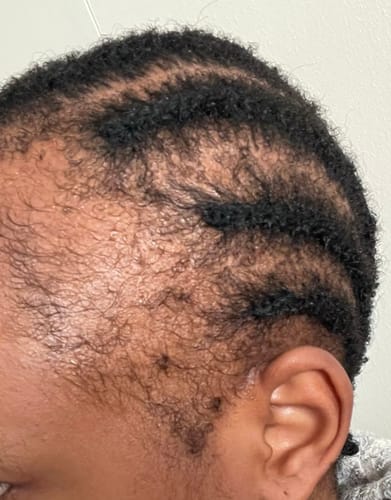 Customer photo review of Minoxidil High Strength (5%) SOLUTION, 3x60ml pack