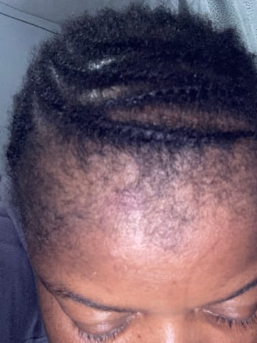 Customer photo review of Minoxidil High Strength (5%) SOLUTION, 3x60ml pack