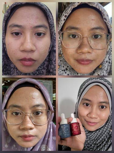 Customer's collage shows skin progress with reduced acne, holding the Radiance & Renewal Duo Serum in the final of four photos.