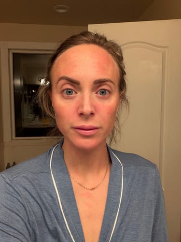Reviewer's face showing temporary redness after using the Seranova Micro Infusion System.