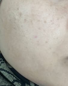 Close-up of a reviewer's cheek showing noticeable pigmentation before using the Pigment Repair Kit.