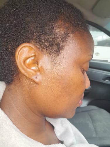 Customer photo review of NOVIFUL Hair Growth Serum - 1 PACK