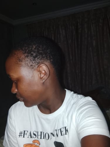 Customer photo review of Minoxidil REGULAR (2%) strength SOLUTION, 1 x 60ml pack