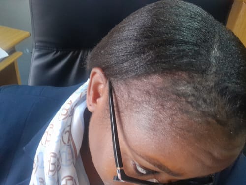 Customer photo review of Minoxidil High Strength (5%) SOLUTION, 3x60ml pack