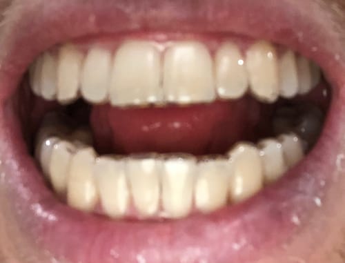 Close-up of a customer's open mouth showing the clear Upper and Lower Retainers Set on their teeth.