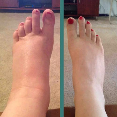 Customer photo review of MEDIAS DE COMPRESIÓN LUMILEGS - Piernas livianas todo el día