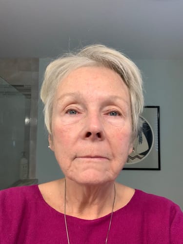 Reviewer's face after using The Micro Infusion System, showing a reduction in fine lines and jowls.
