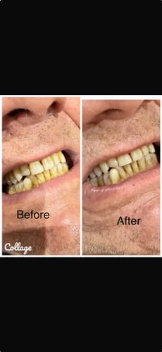Customer photo review of *NEW* MatureSmile™ LED Teeth Whitening Kit | Enamel-Safe Whitening for Adults 40+