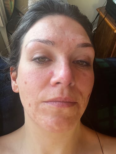Customer's face showing clearer skin after using the Spot Treatment.
