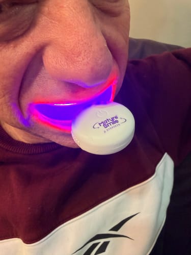 Customer photo review of *NEW* MatureSmile™ LED Teeth Whitening Kit | Enamel-Safe Whitening for Adults 40+