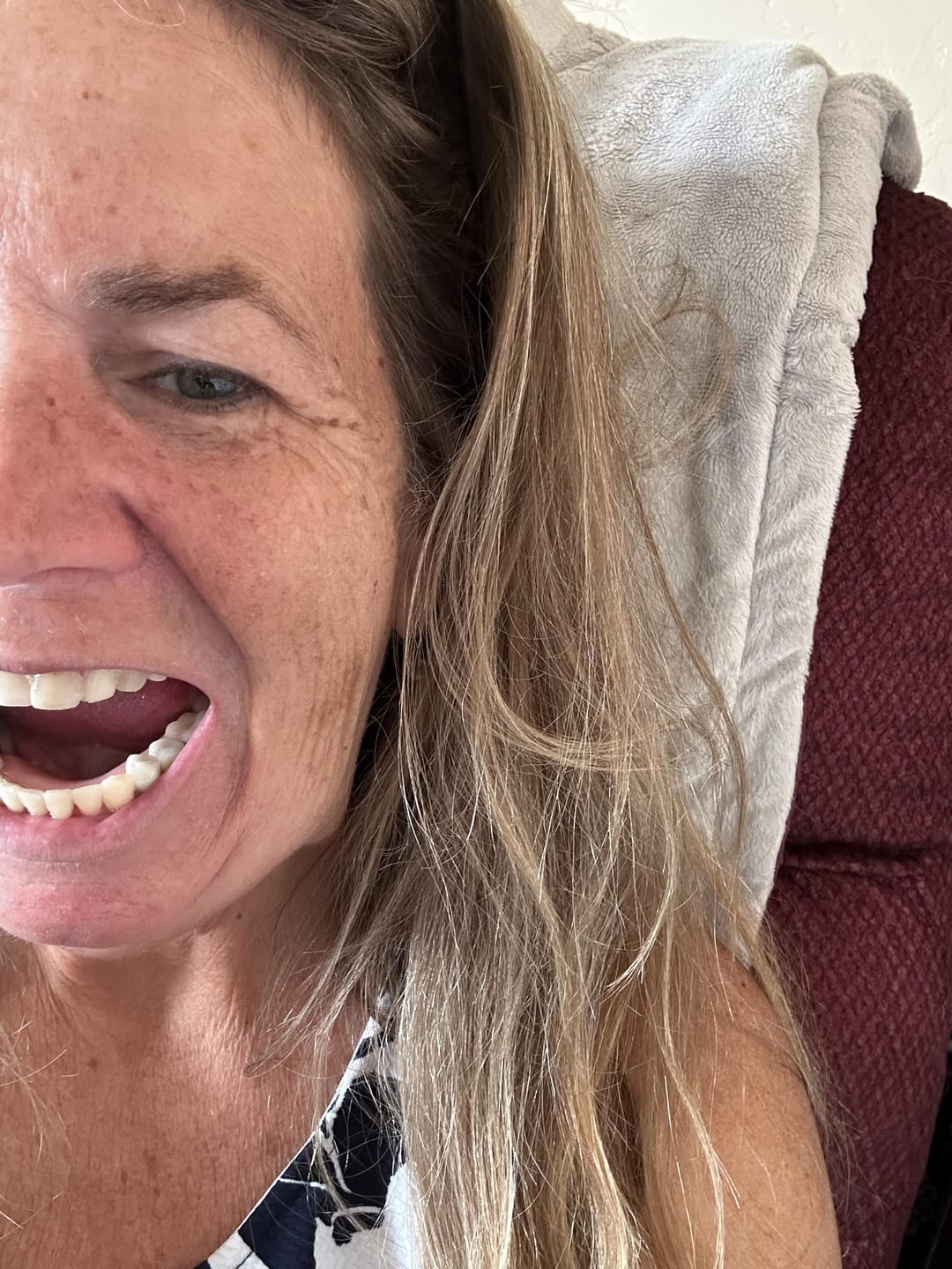 Customer photo review of Acrylic Partial Flipper Denture