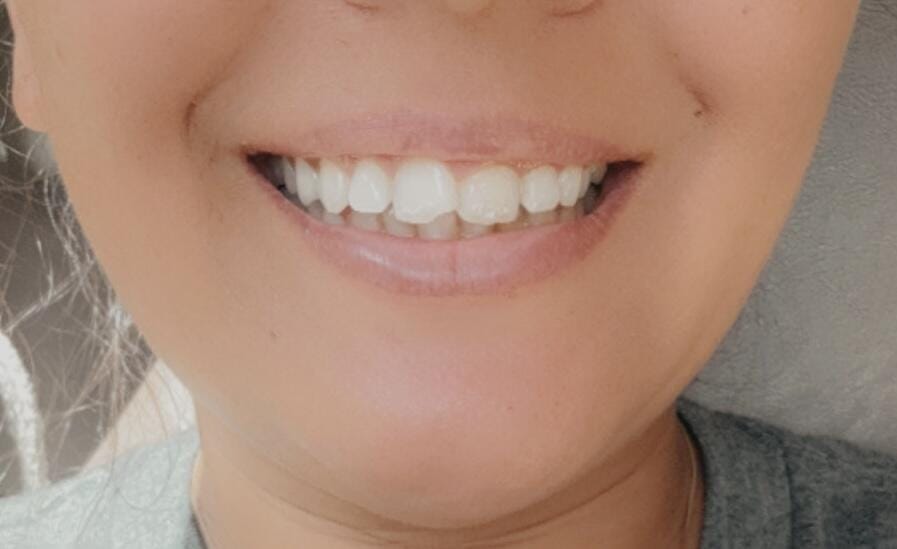 Customer photo review of Flexible Partial Denture