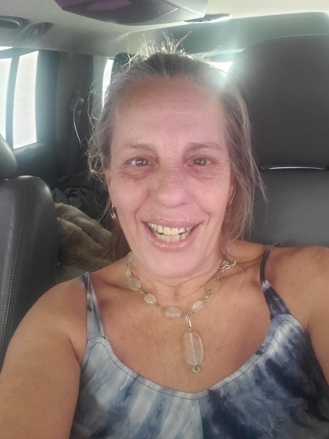 Customer photo review of Acrylic Partial Flipper Denture
