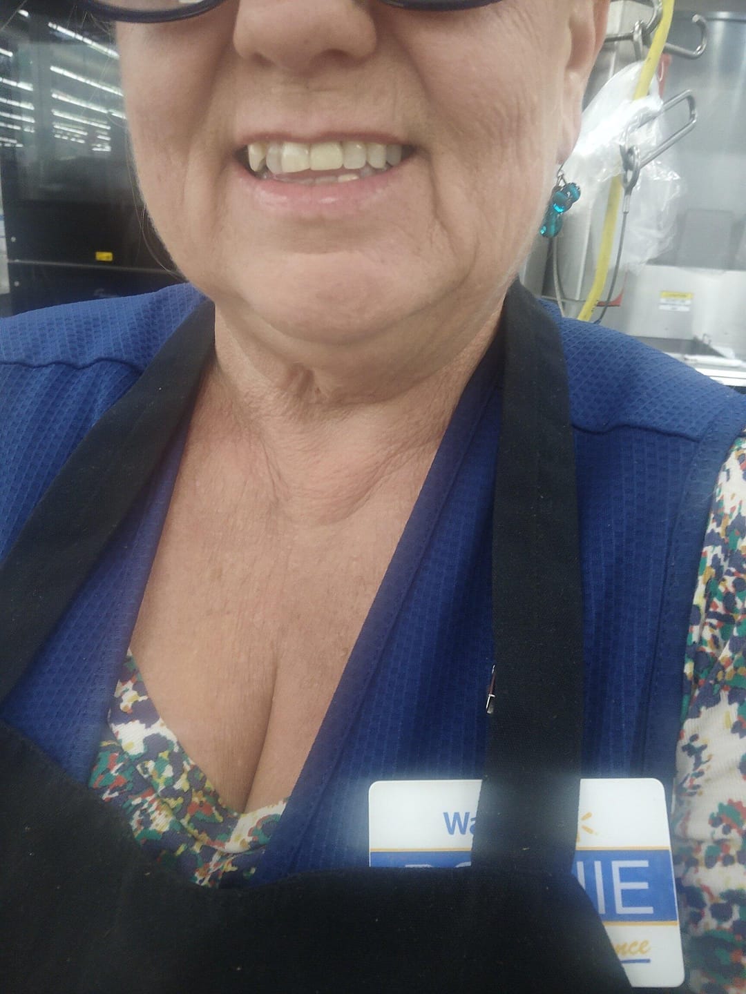 Customer photo review of Acrylic Partial Flipper Denture