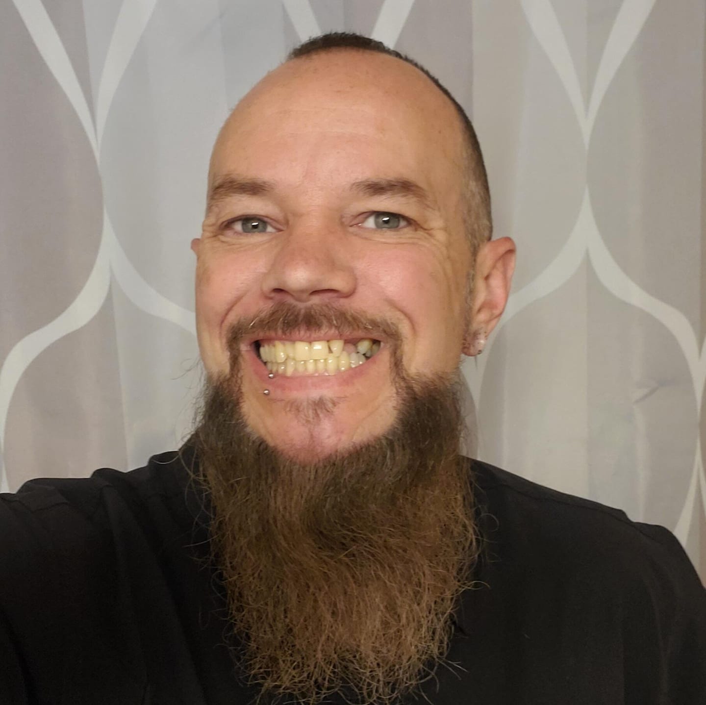 Customer photo review of Unilateral Partial Denture