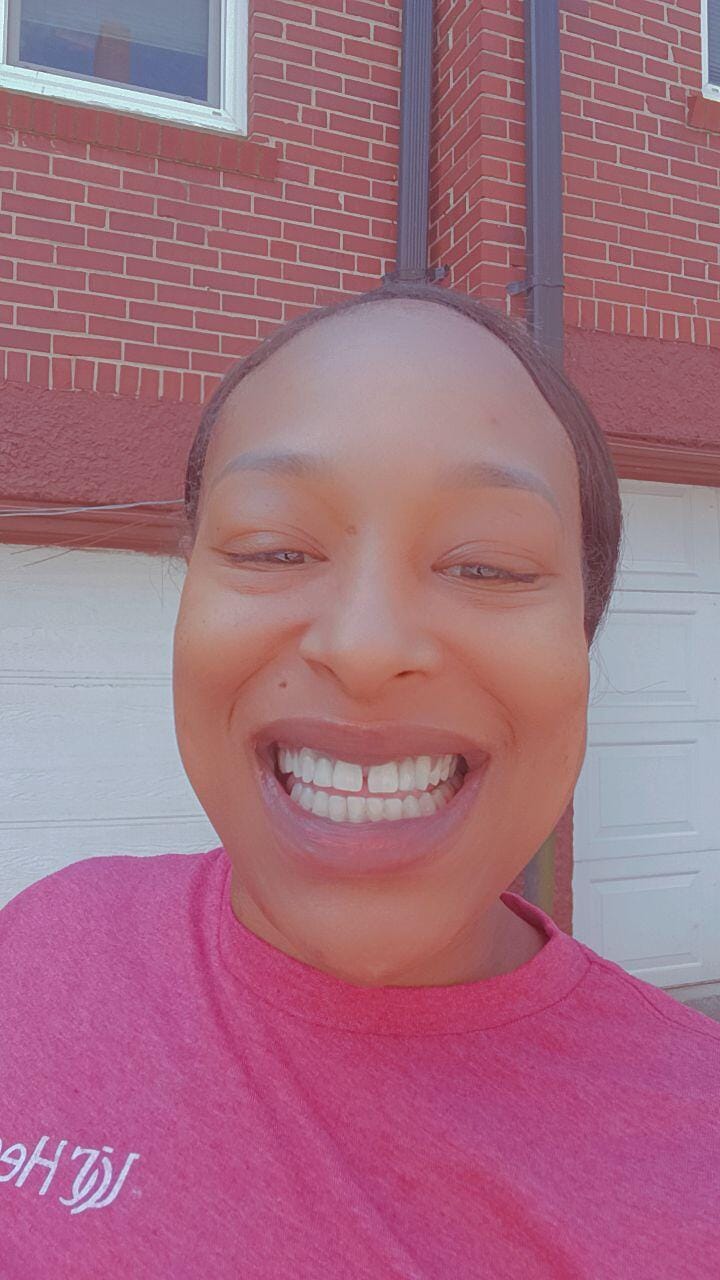 Customer photo review of Clear Flexible Partial Denture