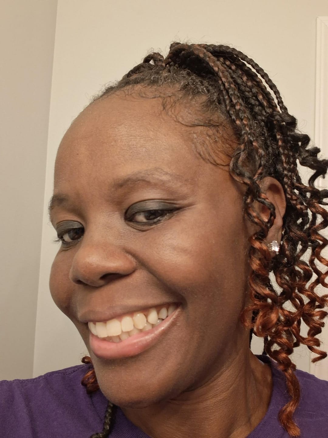 Customer photo review of Flexible Partial Denture