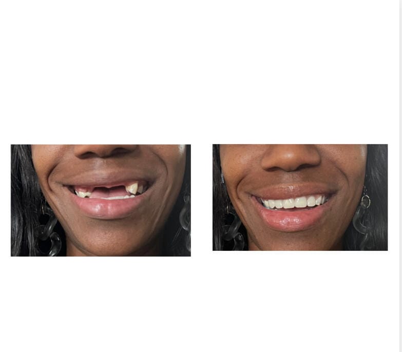 Customer photo review of Flexible Partial Denture