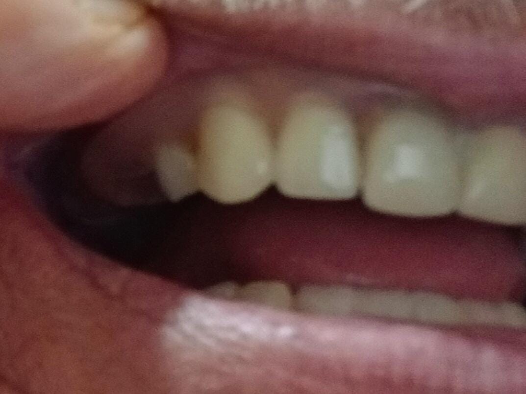 Customer photo review of Flexible Partial Denture