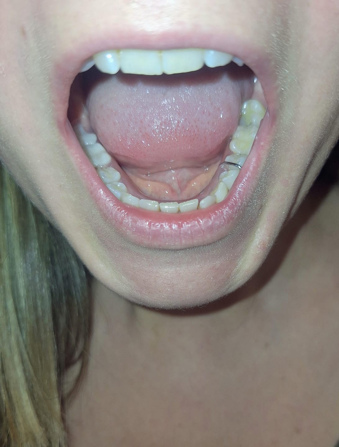 Customer photo review of Unilateral Partial Denture