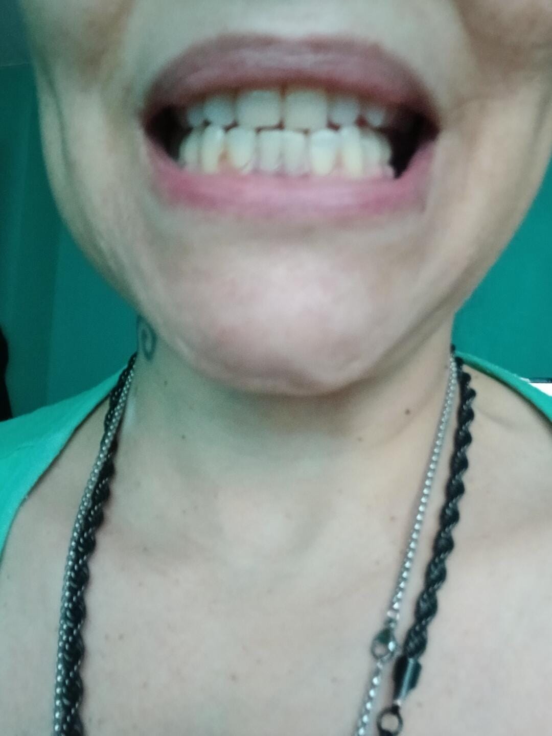 Customer photo review of Unilateral Partial Denture