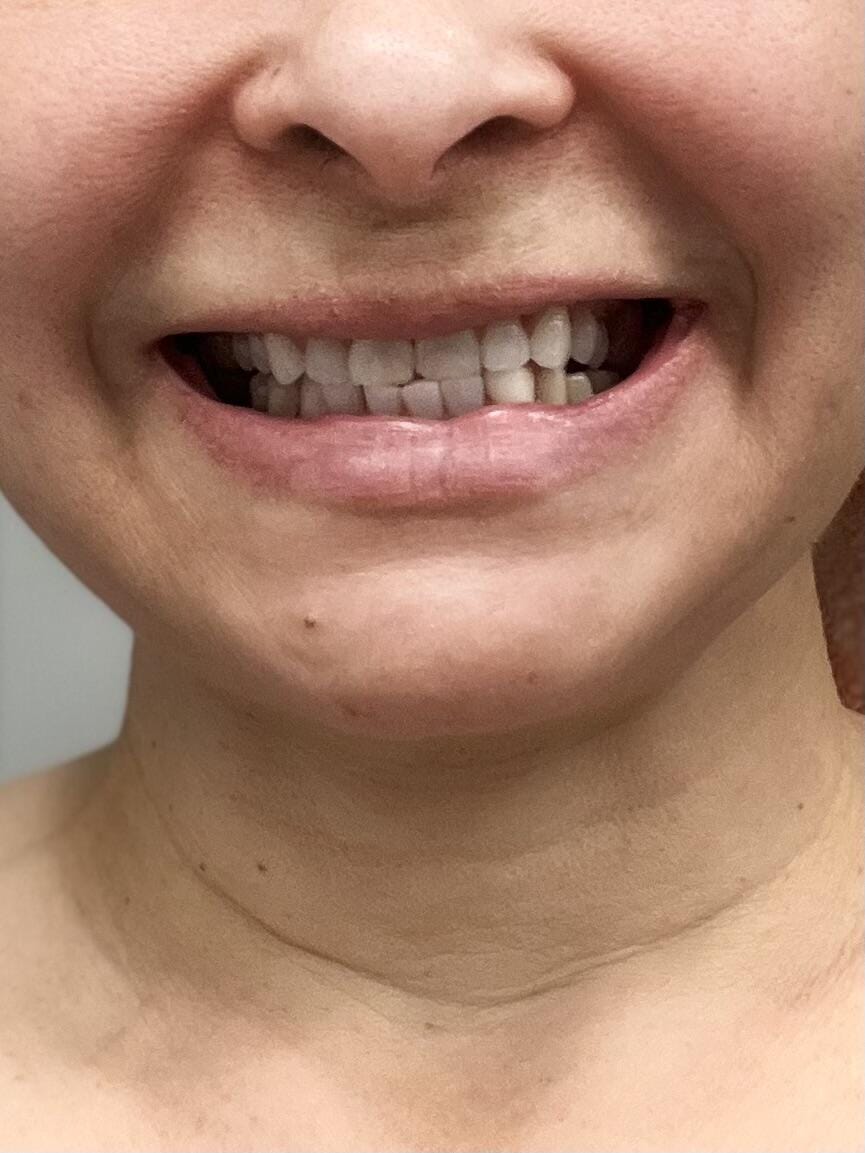 Customer photo review of Clear Unilateral Partial Denture