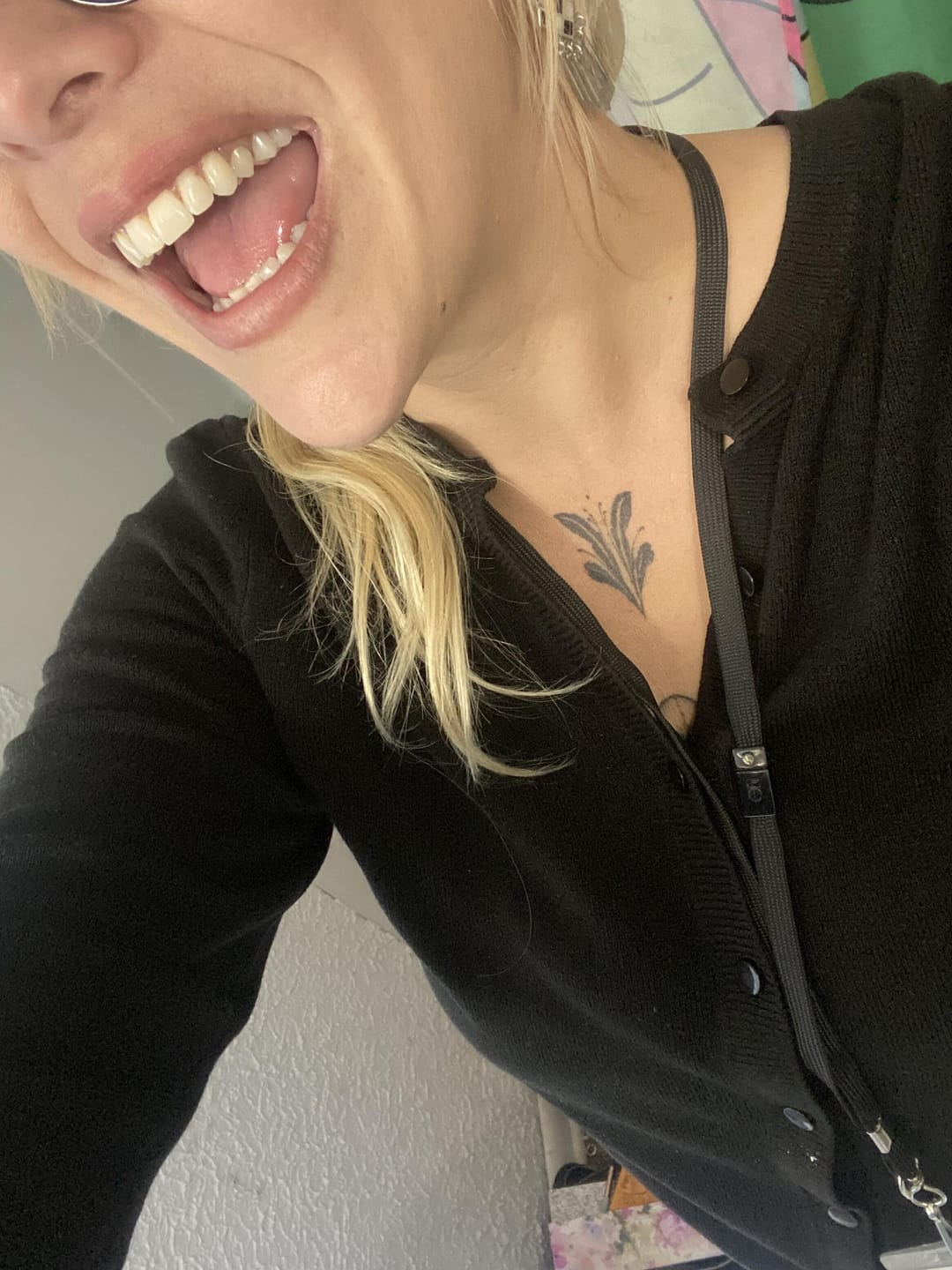 Customer photo review of Unilateral Partial Denture