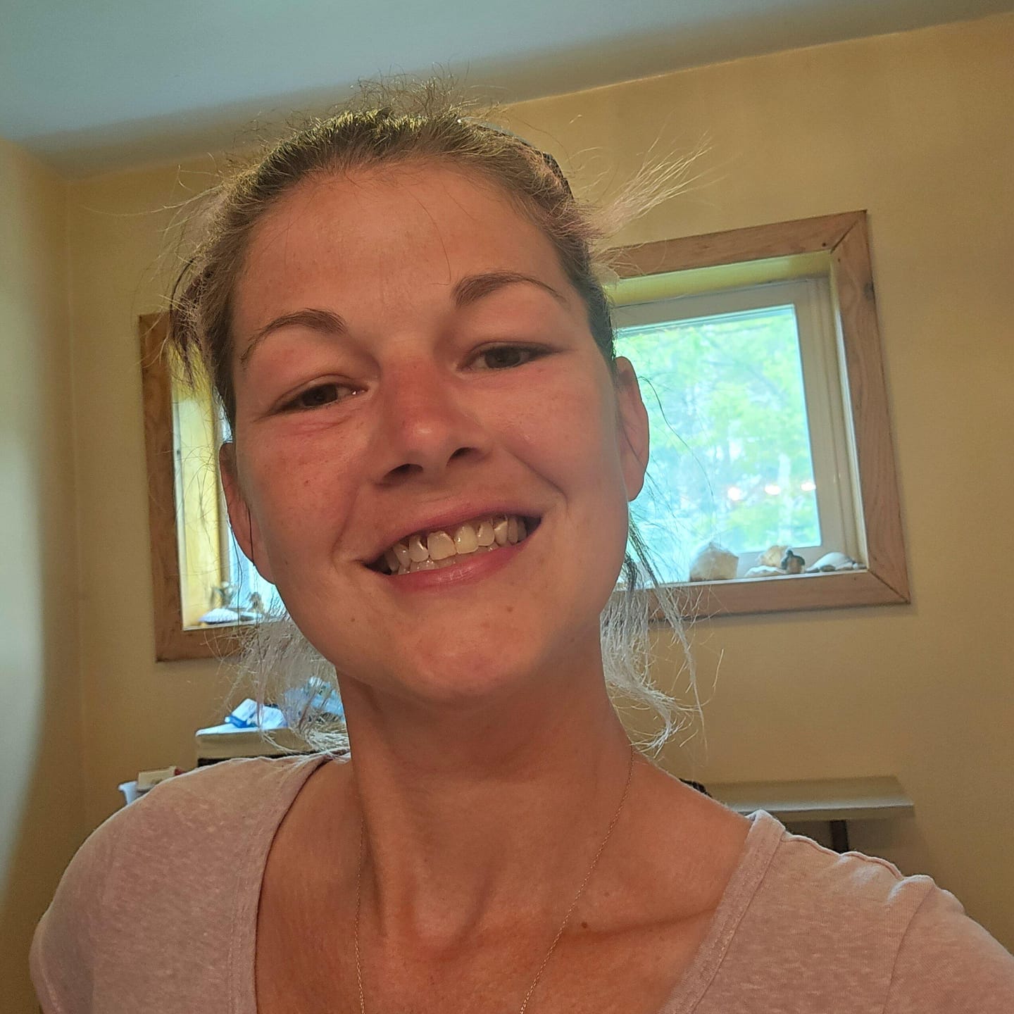 Customer photo review of Unilateral Partial Denture